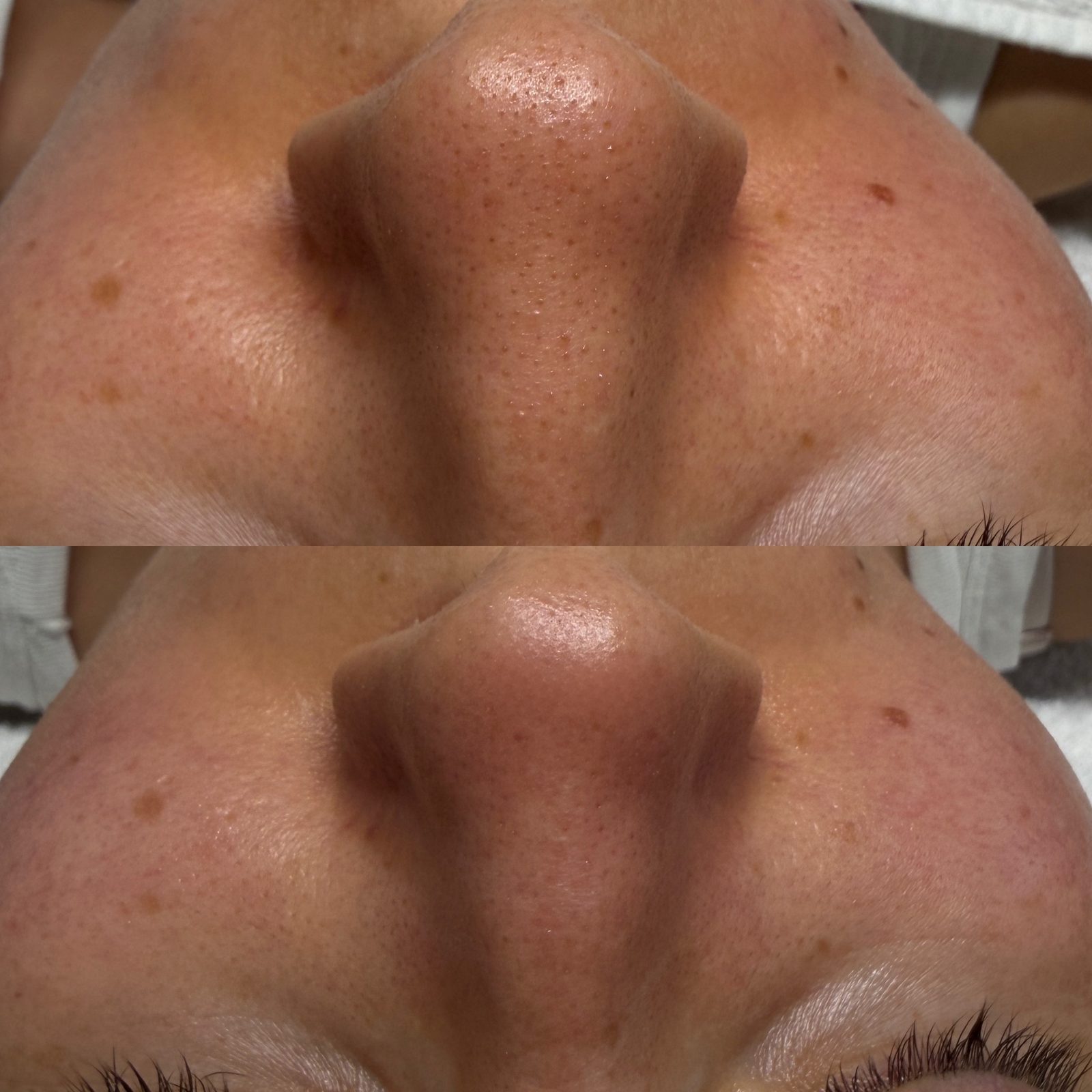 Résultat avant/après d'un soin Hydraskin — nez et pores