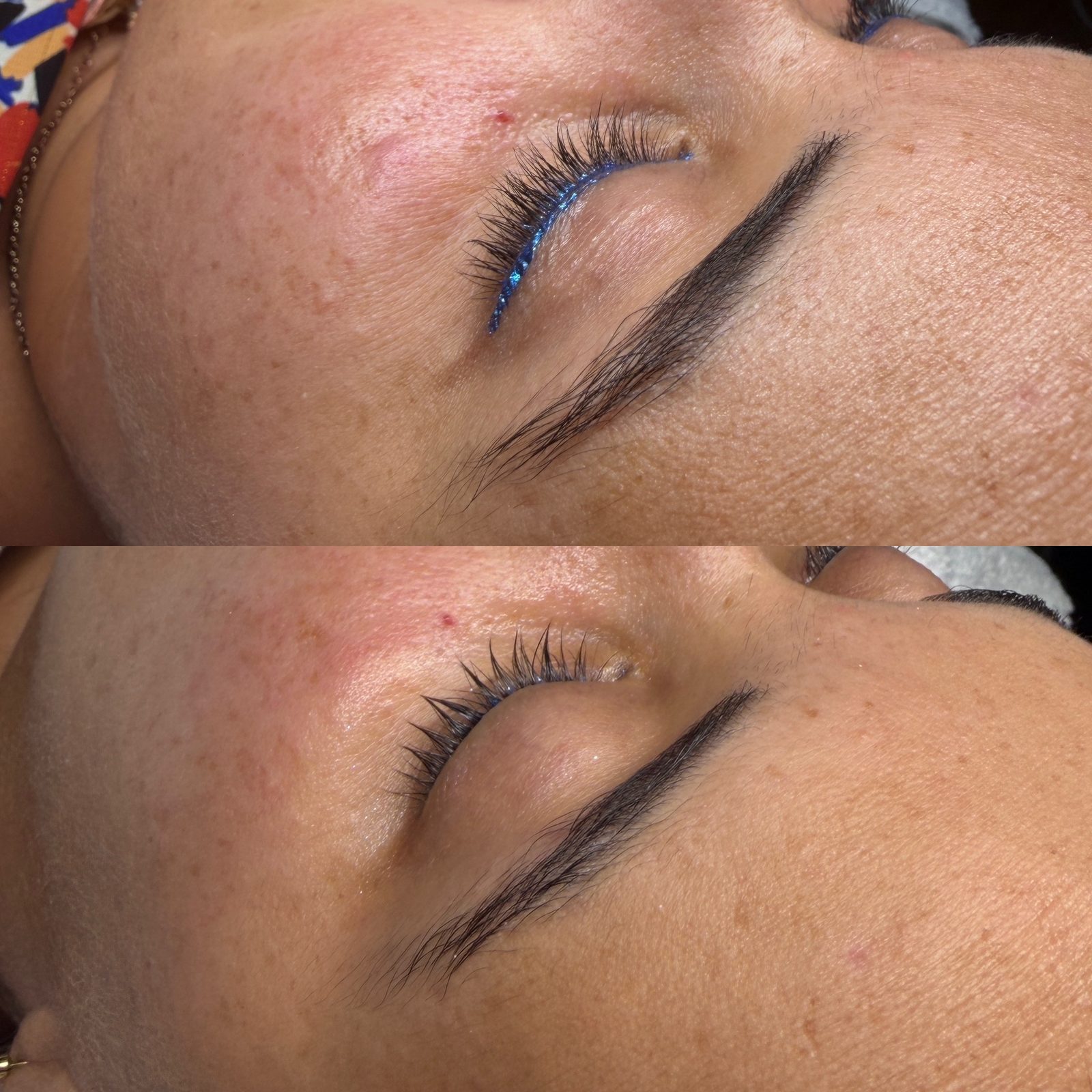 Résultat avant/après d'un soin Hydraskin — contour de l'œil
