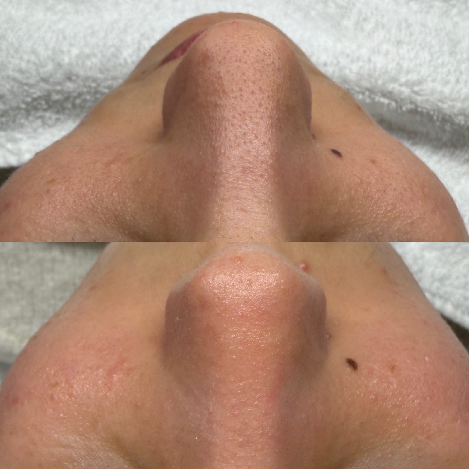 Résultat avant/après d'un soin Hydraskin — nez et pores