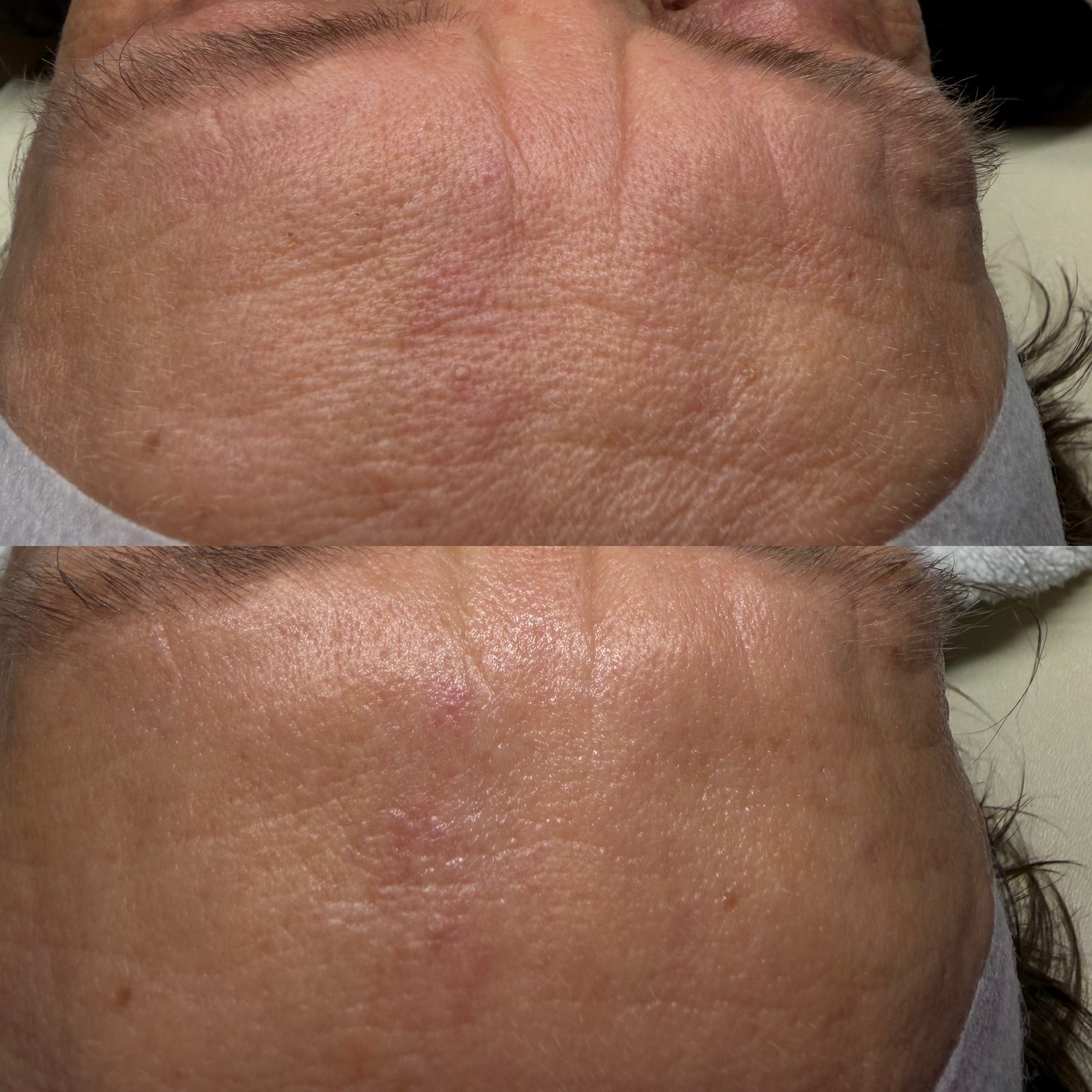 Résultat avant/après d'un soin Hydraskin — front et texture de peau