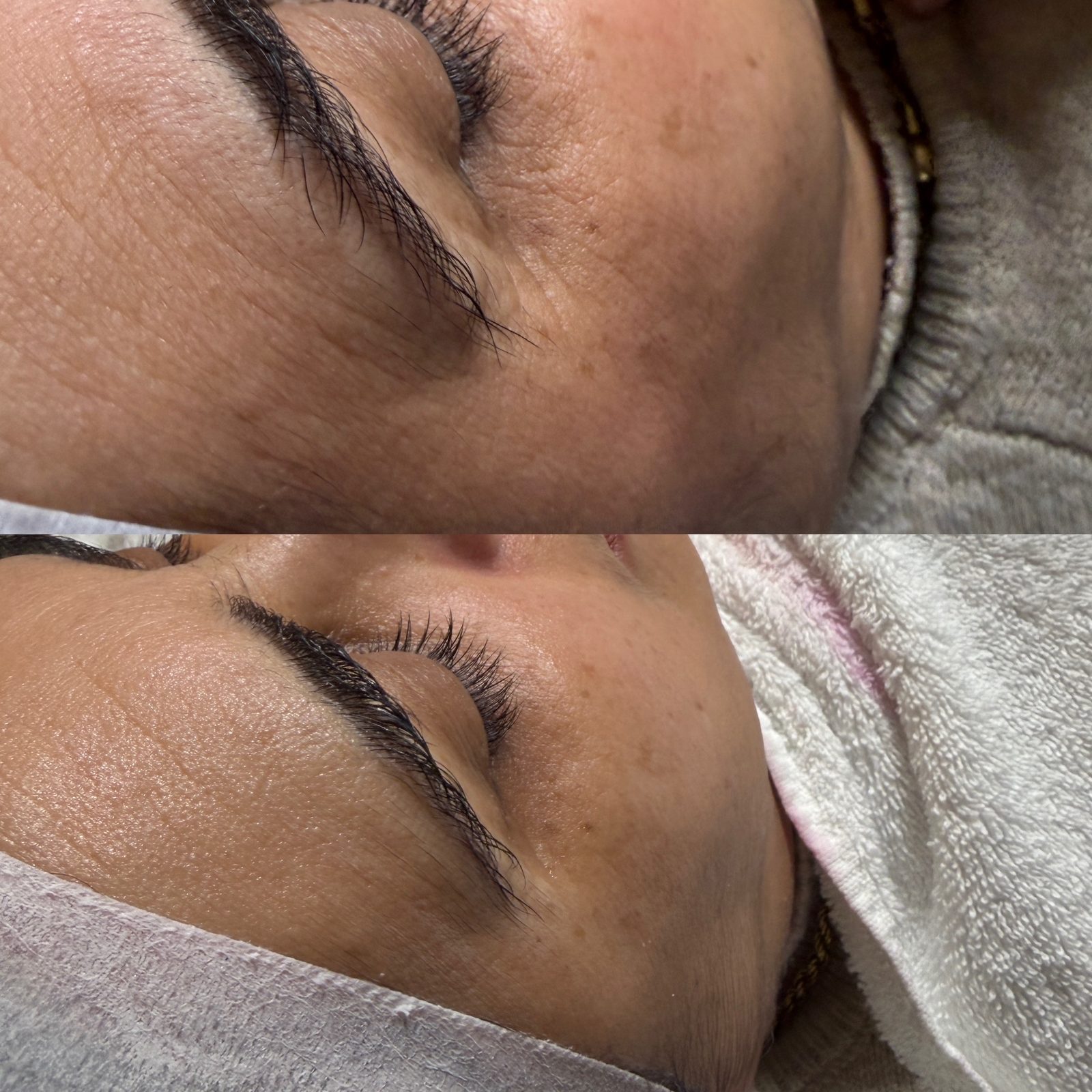 Résultat avant/après d'un soin Hydraskin — contour de l'œil