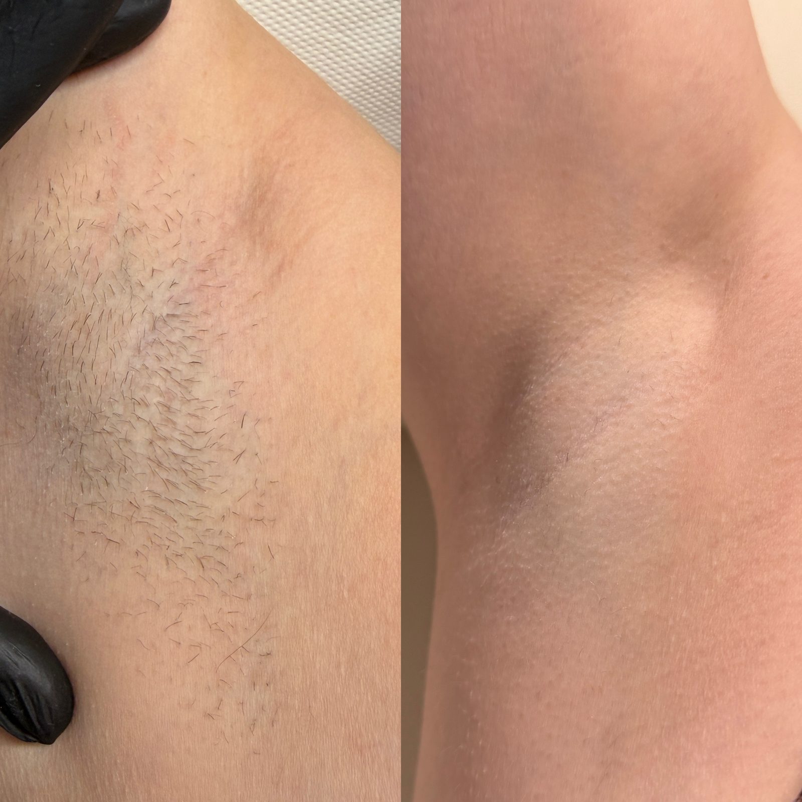 Résultat avant/après épilation laser diode — aisselle après 6 séances