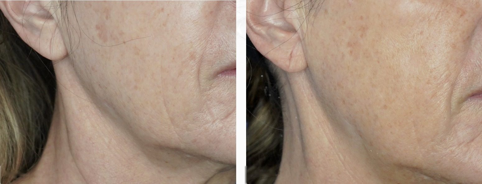 Résultat avant/après microneedling — relâchement et ridules