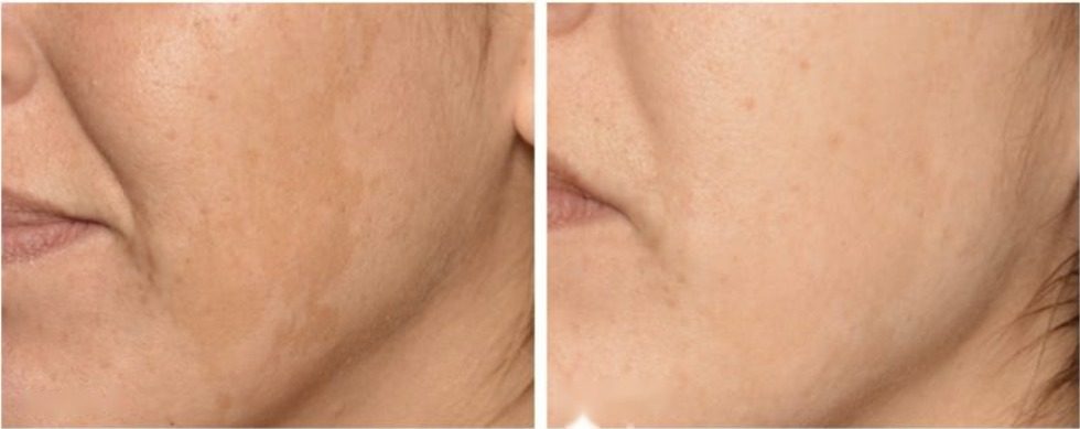 Résultat avant/après microneedling — taches pigmentaires
