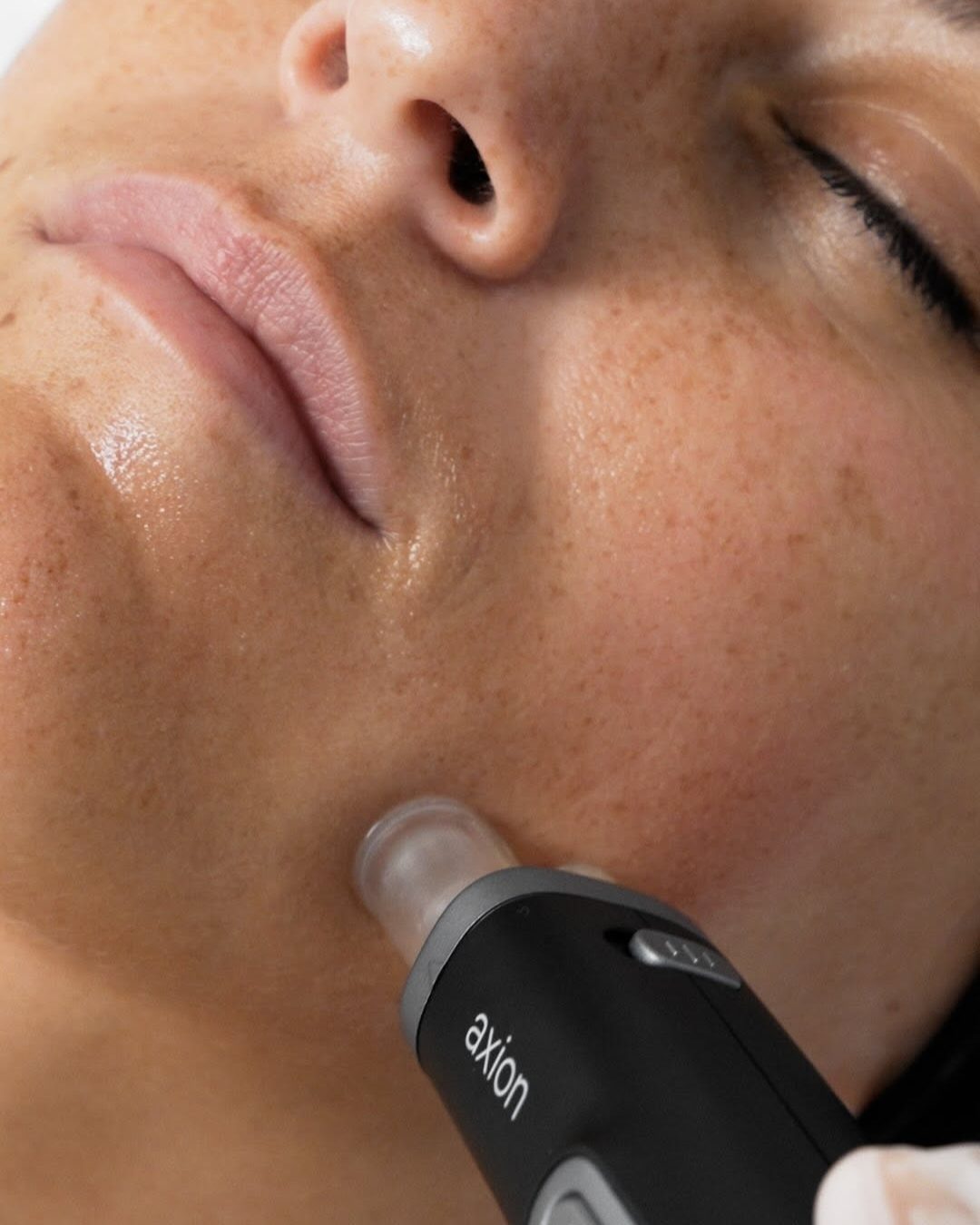 Stylo Axion utilisé lors d'une séance de microneedling